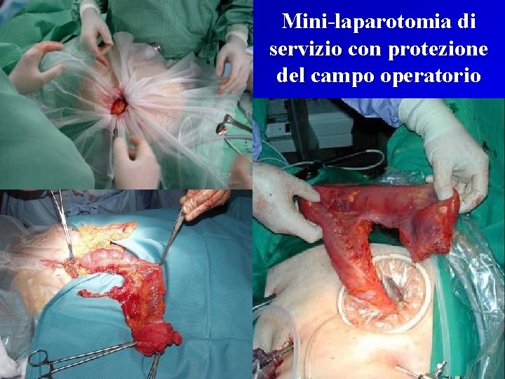 Mini-laparotomia di servizio con protezione del campo operatorio 