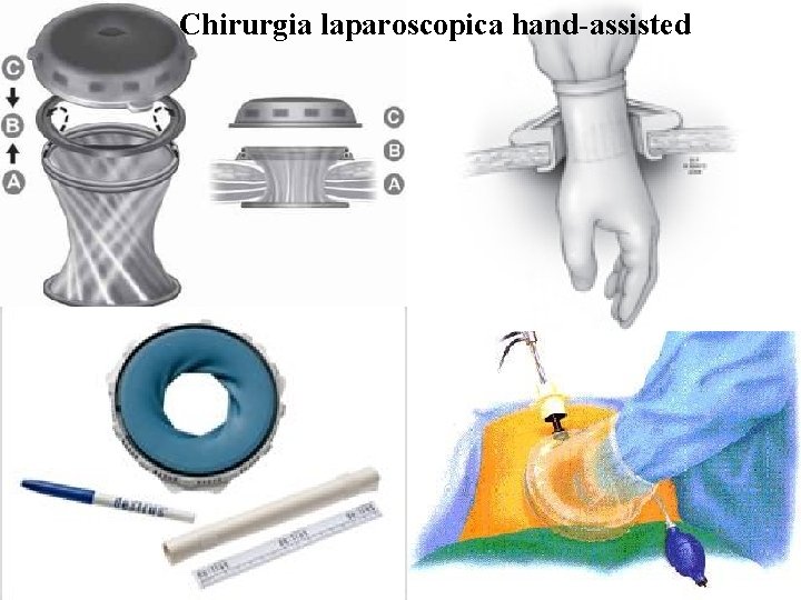Chirurgia laparoscopica hand-assisted 