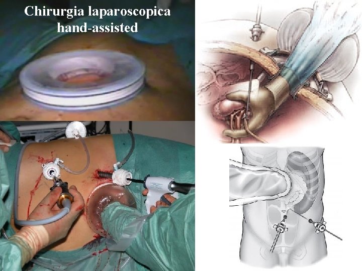 Chirurgia laparoscopica hand-assisted 