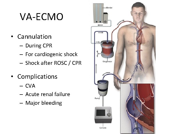 VA-ECMO • Cannulation – During CPR – For cardiogenic shock – Shock after ROSC