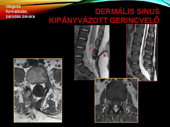 Idegcső formálódás, záródás zavara DERMÁLIS SINUS KIPÁNYVÁZOTT GERINCVELŐ tethered cord, lipoma, spina bifida dermal