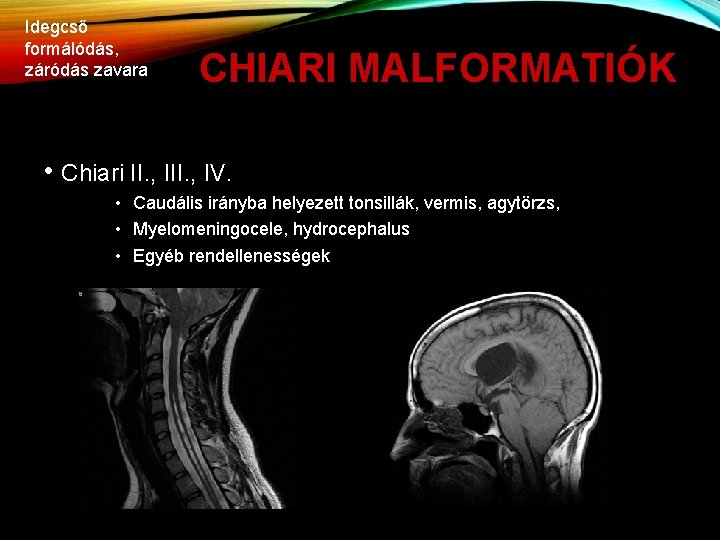 Idegcső formálódás, záródás zavara CHIARI MALFORMATIÓK • Chiari II. , IV. • Caudális irányba