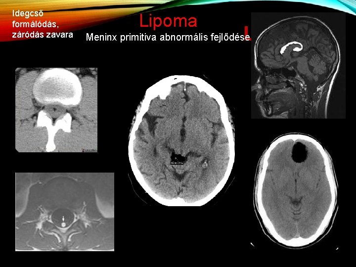Idegcső formálódás, záródás zavara Lipoma LIPOMÁK Meninx primitiva abnormális fejlődése 