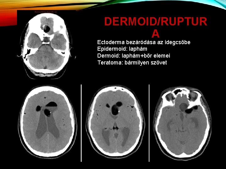 DERMOID/RUPTUR A Ectoderma bezáródása az idegcsőbe Epidermoid: laphám Dermoid: laphám+bőr elemei Teratoma: bármilyen szövet