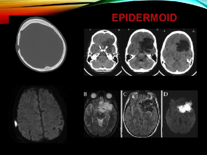 EPIDERMOID 