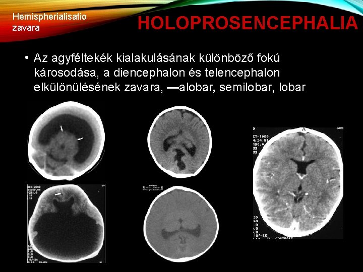 Hemispherialisatio zavara HOLOPROSENCEPHALIA • Az agyféltekék kialakulásának különböző fokú károsodása, a diencephalon és telencephalon