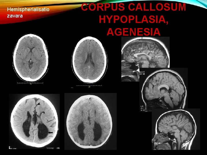 Hemispherialisatio zavara CORPUS CALLOSUM HYPOPLASIA, AGENESIA 