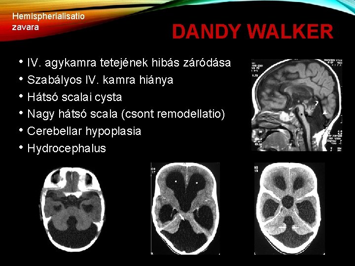 Hemispherialisatio zavara DANDY WALKER • IV. agykamra tetejének hibás záródása • Szabályos IV. kamra