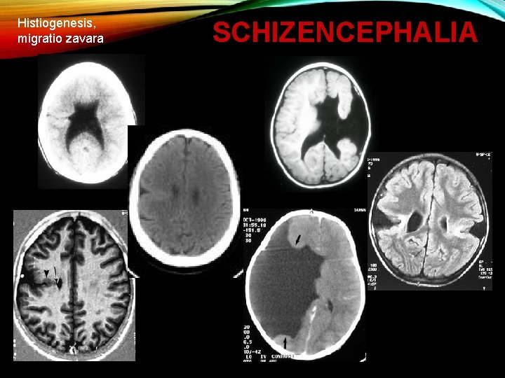 Histiogenesis, migratio zavara SCHIZENCEPHALIA 