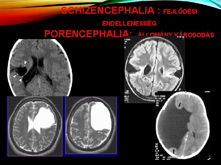 SCHIZENCEPHALIA : FEJLŐDÉSI ENDELLENESSÉG PORENCEPHALIA: ÁLLOMÁNY KÁROSODÁS 