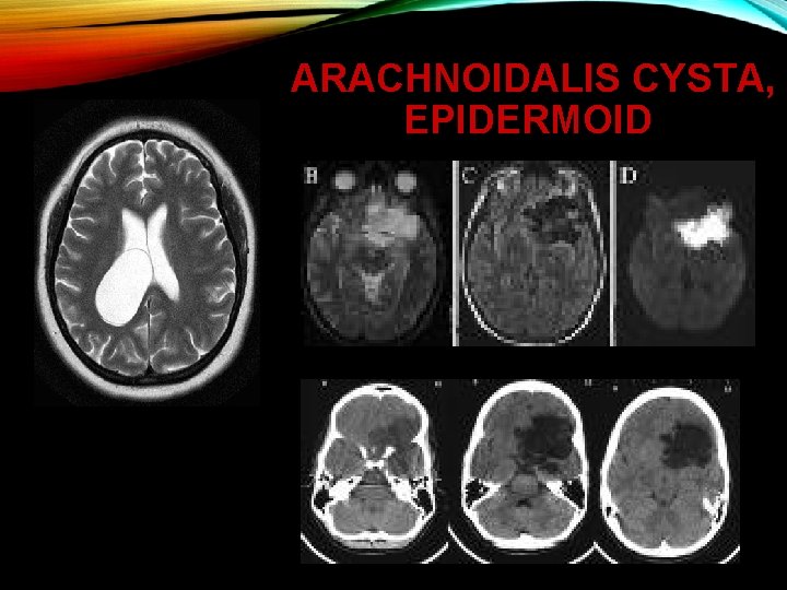 ARACHNOIDALIS CYSTA, EPIDERMOID 