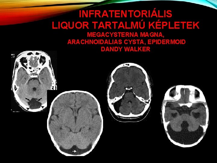 INFRATENTORIÁLIS LIQUOR TARTALMÚ KÉPLETEK MEGACYSTERNA MAGNA, ARACHNOIDALIAS CYSTA, EPIDERMOID DANDY WALKER 