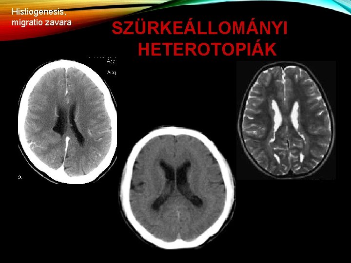 Histiogenesis, migratio zavara SZÜRKEÁLLOMÁNYI HETEROTOPIÁK 