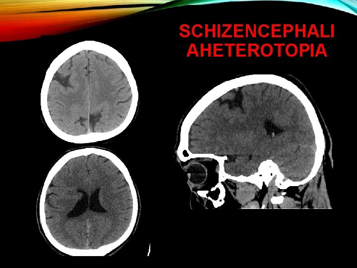 SCHIZENCEPHALI AHETEROTOPIA 