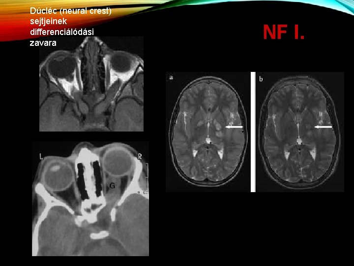 Dúcléc (neural crest) sejtjeinek differenciálódási zavara NF I. 