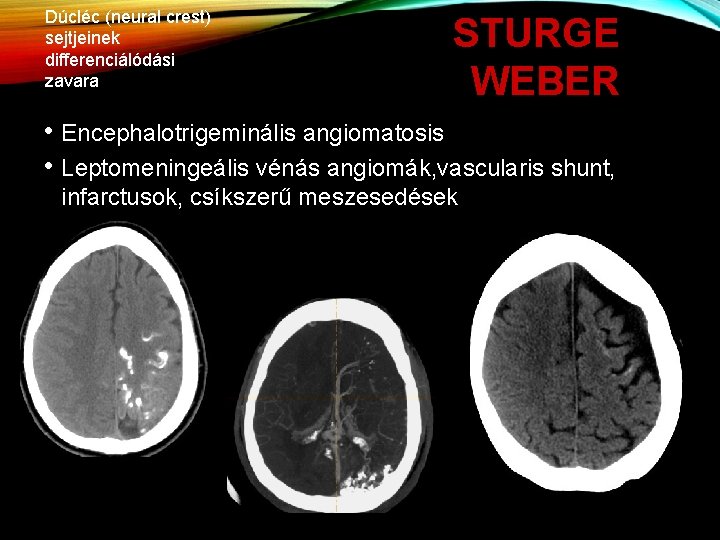 Dúcléc (neural crest) sejtjeinek differenciálódási zavara STURGE WEBER • Encephalotrigeminális angiomatosis • Leptomeningeális vénás