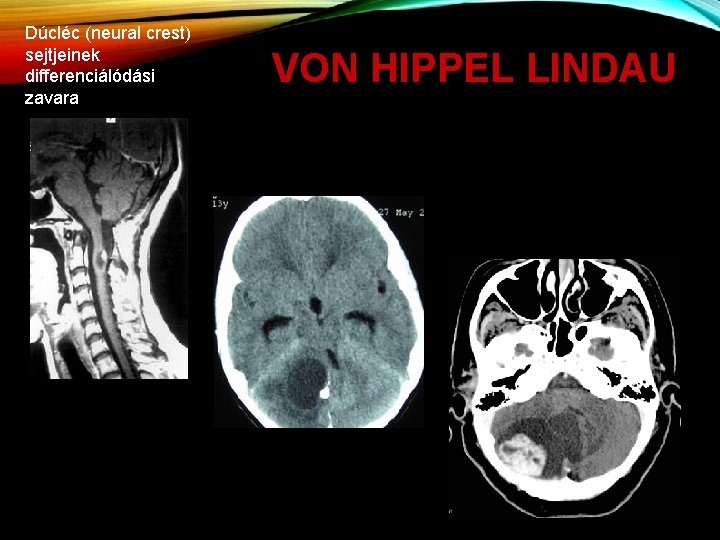 Dúcléc (neural crest) sejtjeinek differenciálódási zavara VON HIPPEL LINDAU 