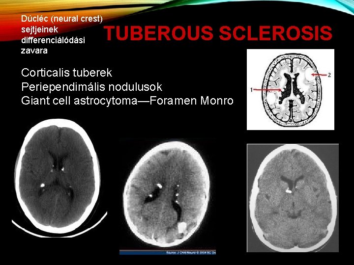Dúcléc (neural crest) sejtjeinek differenciálódási zavara TUBEROUS SCLEROSIS Corticalis tuberek Periependimális nodulusok Giant cell