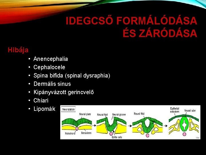 IDEGCSŐ FORMÁLÓDÁSA ÉS ZÁRÓDÁSA Hibája • • Anencephalia Cephalocele Spina bifida (spinal dysraphia) Dermális