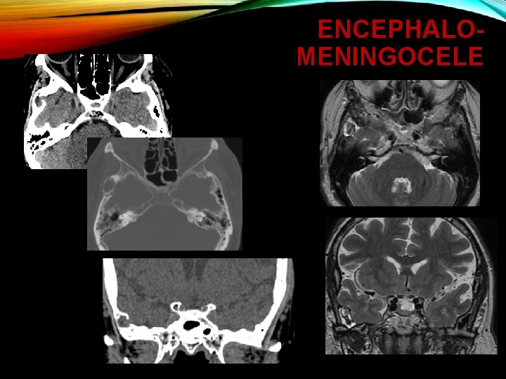 ENCEPHALOMENINGOCELE 