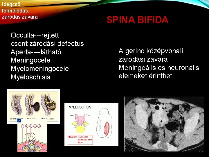 Idegcső formálódás, záródás zavara Occulta---rejtett csont záródási defectus Aperta----látható Meningocele Myelomeningocele Myeloschisis SPINA BIFIDA