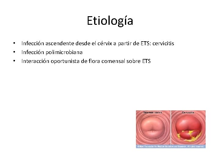 Etiología • Infección ascendente desde el cérvix a partir de ETS: cervicitis • Infección Etiología • Infección ascendente desde el cérvix a partir de ETS: cervicitis • Infección