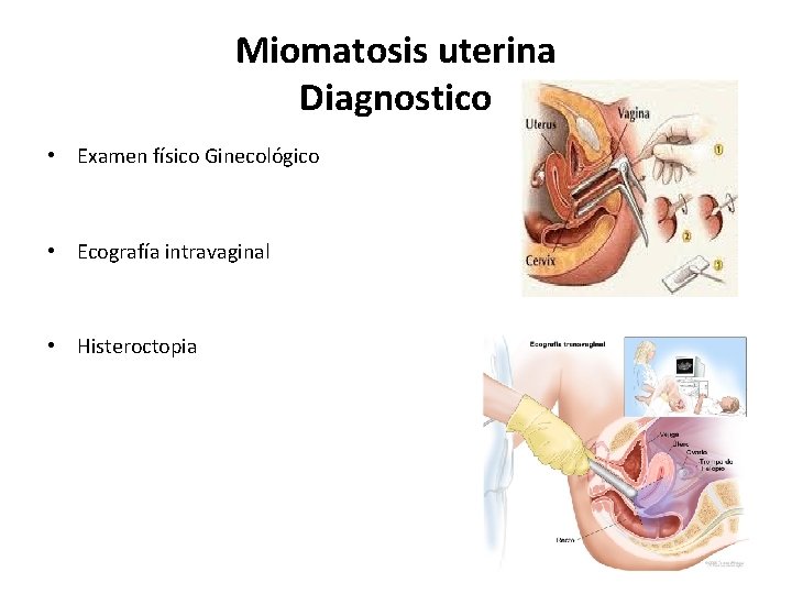 Miomatosis uterina Diagnostico • Examen físico Ginecológico • Ecografía intravaginal • Histeroctopia 