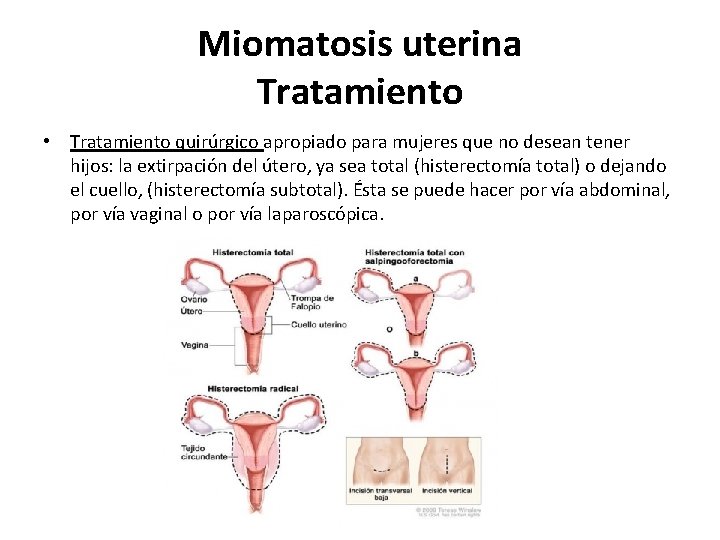 Miomatosis uterina Tratamiento • Tratamiento quirúrgico apropiado para mujeres que no desean tener hijos: