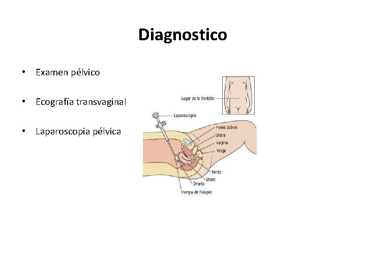Diagnostico • Examen pélvico • Ecografía transvaginal • Laparoscopia pélvica 