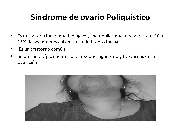 Síndrome de ovario Poliquistico • Es una alteración endocrinológico y metabólica que afecta entre Síndrome de ovario Poliquistico • Es una alteración endocrinológico y metabólica que afecta entre