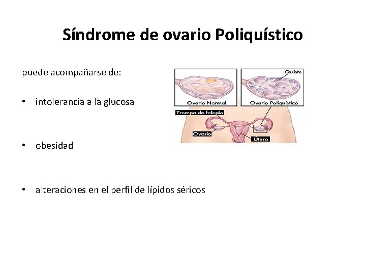Síndrome de ovario Poliquístico puede acompañarse de: • intolerancia a la glucosa • obesidad Síndrome de ovario Poliquístico puede acompañarse de: • intolerancia a la glucosa • obesidad