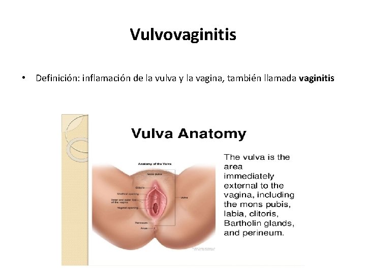 Vulvovaginitis • Definición: inflamación de la vulva y la vagina, también llamada vaginitis 