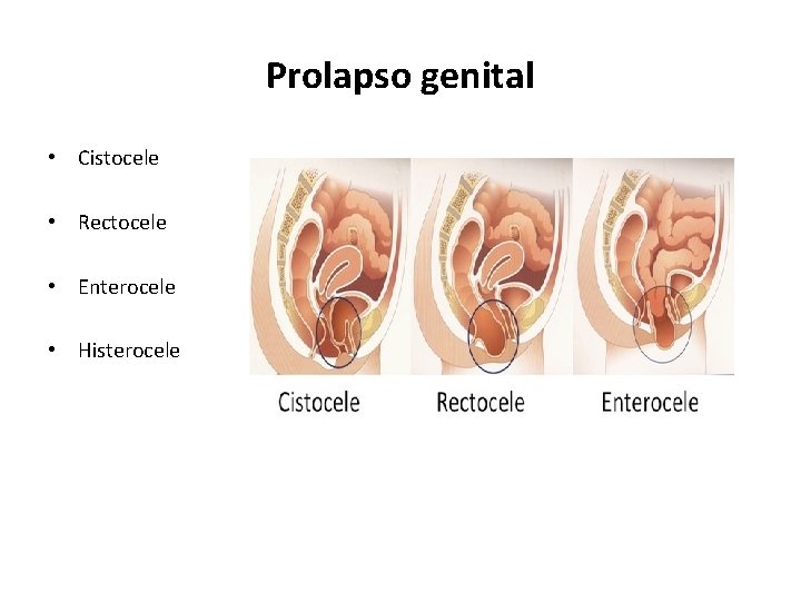 Prolapso genital • Cistocele • Rectocele • Enterocele • Histerocele 