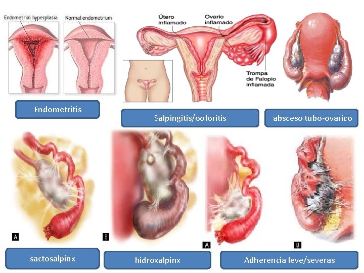 Endometritis sactosalpinx Salpingitis/ooforitis hidroxalpinx absceso tubo-ovarico Adherencia leve/severas 