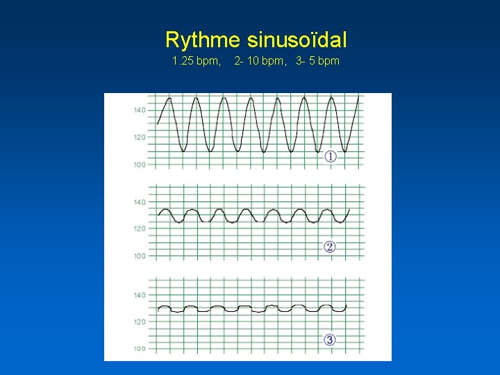 Rythme sinusoïdal 1. 25 bpm, 2 - 10 bpm, 3 - 5 bpm 