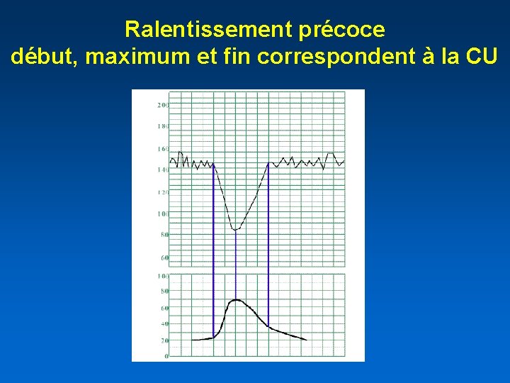  Ralentissement précoce début, maximum et fin correspondent à la CU 