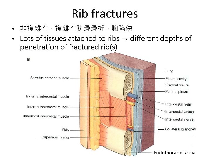 Rib fractures • 非複雜性、複雜性肋骨骨折、胸陷傷 • Lots of tissues attached to ribs → different depths