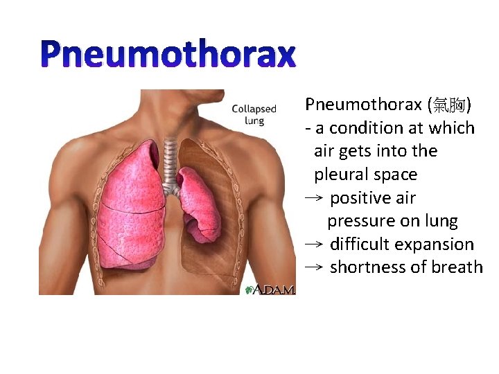 Pneumothorax (氣胸) - a condition at which air gets into the pleural space →