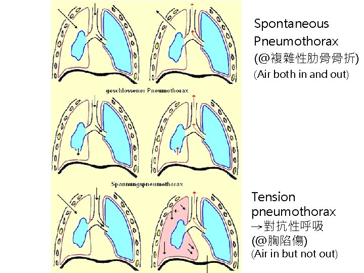 Spontaneous Pneumothorax (@複雜性肋骨骨折) (Air both in and out) Tension pneumothorax →對抗性呼吸 (@胸陷傷) (Air in