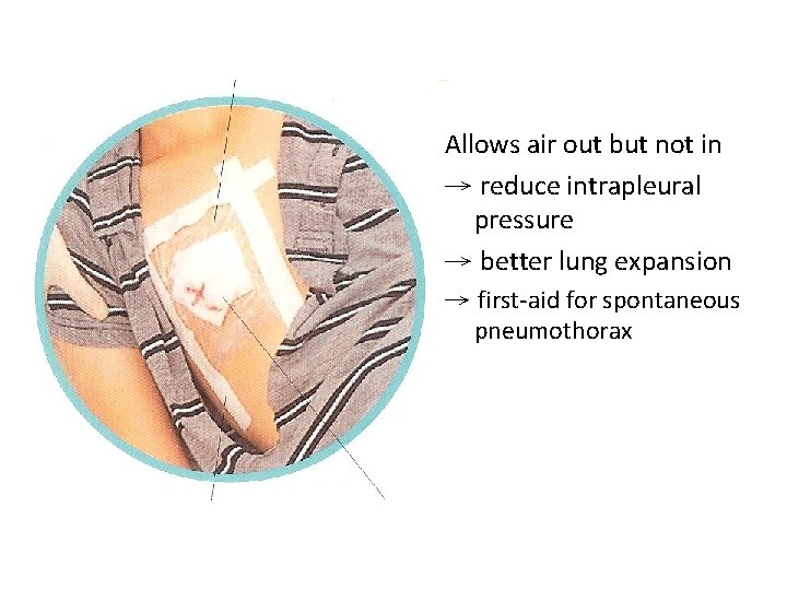 Allows air out but not in → reduce intrapleural pressure → better lung expansion