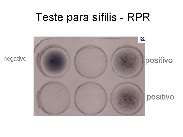 Teste para sífilis - RPR negativo positivo 
