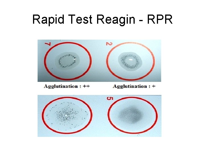Rapid Test Reagin - RPR 