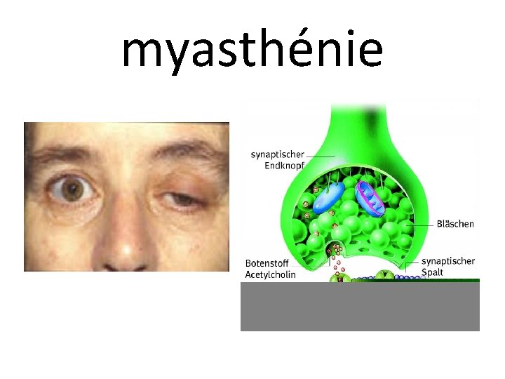 myasthénie 