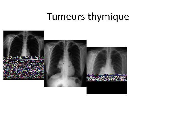 Tumeurs thymique 