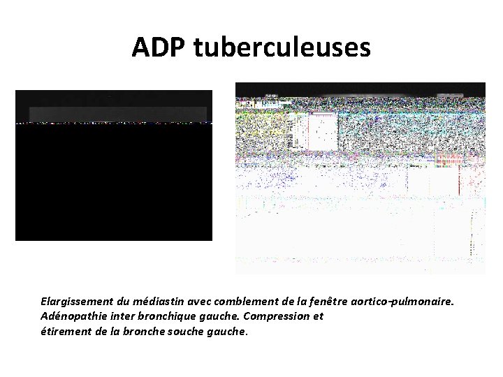 ADP tuberculeuses Elargissement du médiastin avec comblement de la fenêtre aortico-pulmonaire. Adénopathie inter bronchique