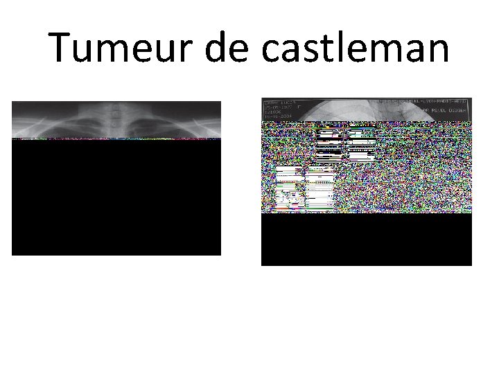 Tumeur de castleman 