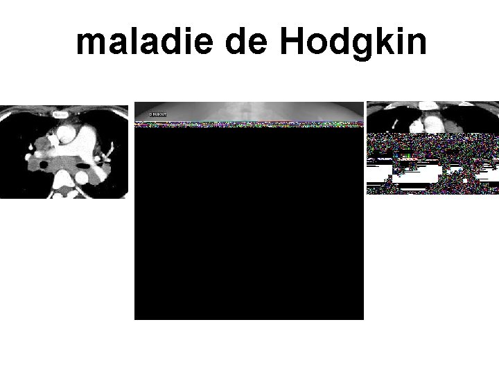 maladie de Hodgkin 