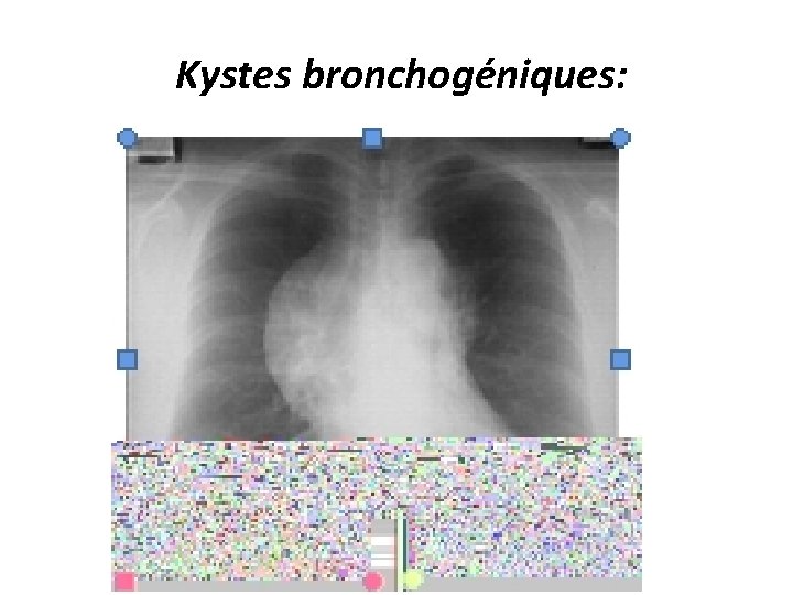  Kystes bronchogéniques: 