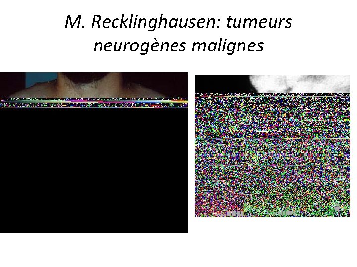 M. Recklinghausen: tumeurs neurogènes malignes 