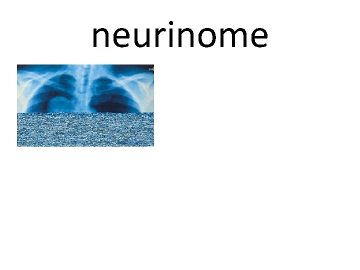 neurinome 